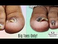 👣Big Toes Only - How to Restore DARK TOENAILS👣