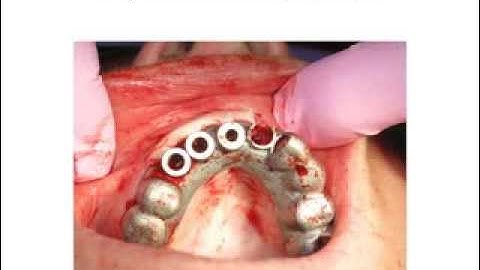 Bicon and Quantum guided surgery protocol CrystalGuide clinical case Dr. Igor Kaplansky