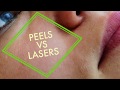 Peels Vs Lasers (2 Q&As with a Facial Plastic Surgeon)