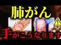 【超意外な初期症状】放置厳禁!知らないと後悔する肺がんの「手」の危険サイン。指の形.手首の腫れ掌の変化..意外な兆候とは?五十肩だと思ったらまさかの..肺がんに予防法はあるのか?医師が徹底解説。