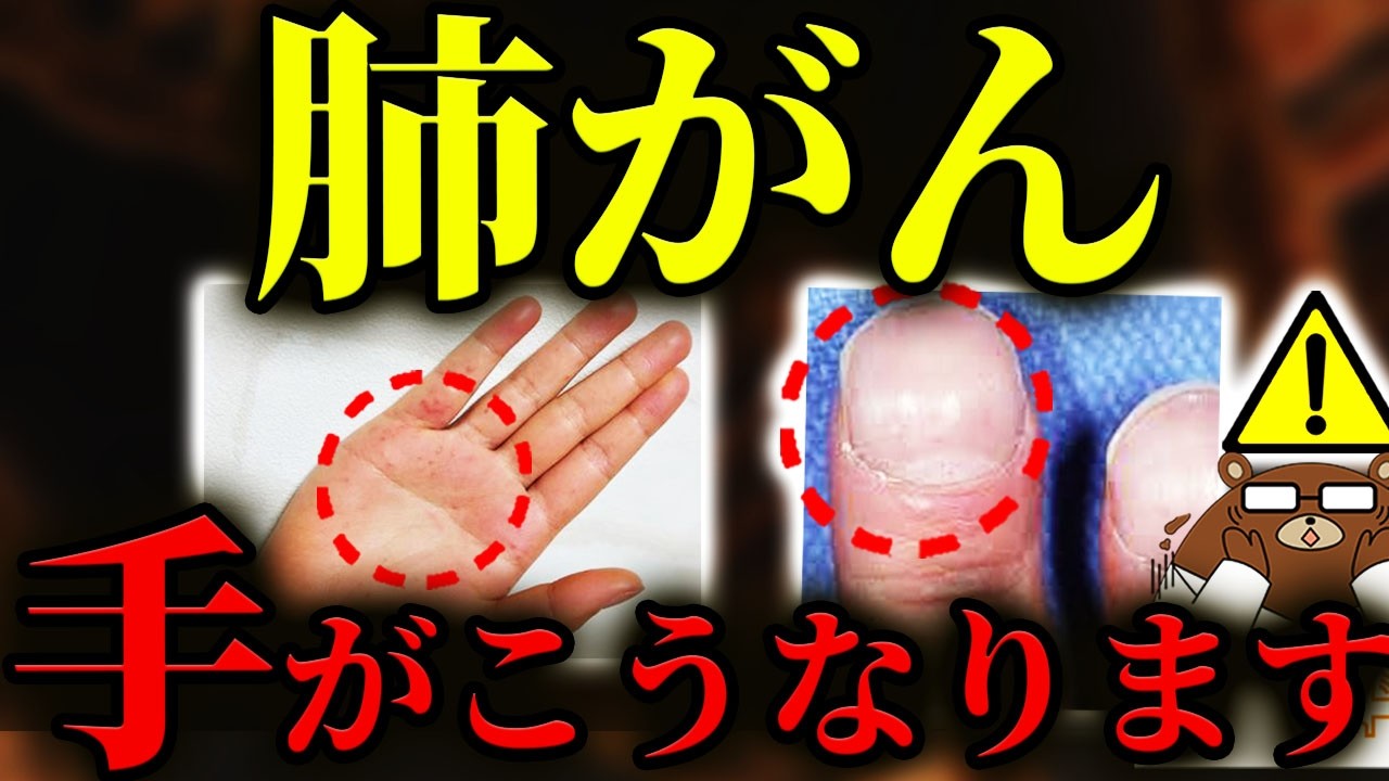 【超意外な初期症状】放置厳禁！知らないと後悔する肺がんの「手」の危険サイン。指の形.手首の腫れ掌の変化..意外な兆候とは？五十肩だと思ったらまさかの..肺がんに予防法はあるのか？医師が徹底解説。