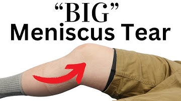 Meniscus Tear (Exam) Bucket Handle Tear