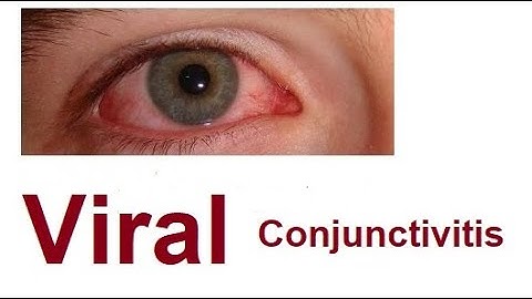 Viral Conjunctivitis