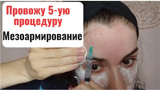 МЕЗОТЕРАПИЯ СВОИМИ РУКАМИ. Биорепарация для своего лица. Уколы красоты самой себе.
