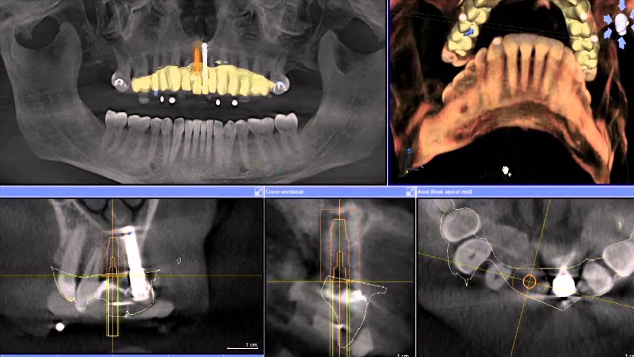 Dr. Andrews' Dental Implant Dentistry YouTube