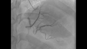 Cases performed encompassing weights ranging from 95kg to 118kg.