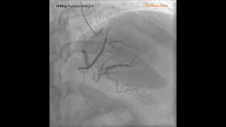Cases performed encompassing weights ranging from 95kg to 118kg.