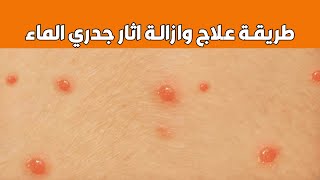 طريقة علاج وازاله اثار جدري الماء عند الاطفال والكبار