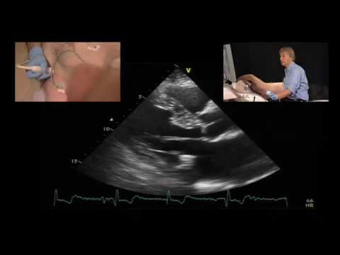 Image of Assessment of Masses in Echocardiography