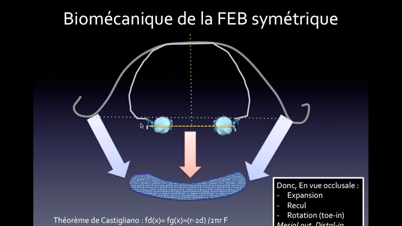 Biomécanique Orthodontique N°4 : FEB/FEO ou Headgear