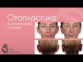 Отопластика: клинический случай - Софья Чаушева