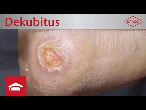 Video: Adakah hilft bei dekubitus?