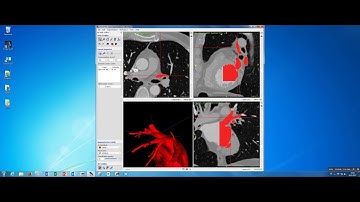 itk snap automatic segmentation with presegmentation mode classification in 6 minutes