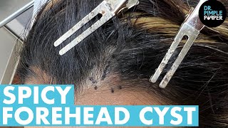 Dr Pimple Popper POPS a MASSIVE Forehead Cyst!