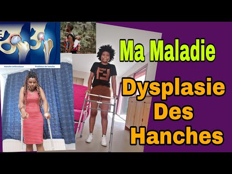 Vidéo: Ce que vous devez savoir sur la dysplasie de la hanche