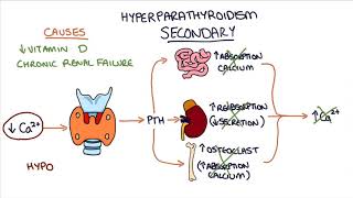 Understanding Hyperparathyroidism