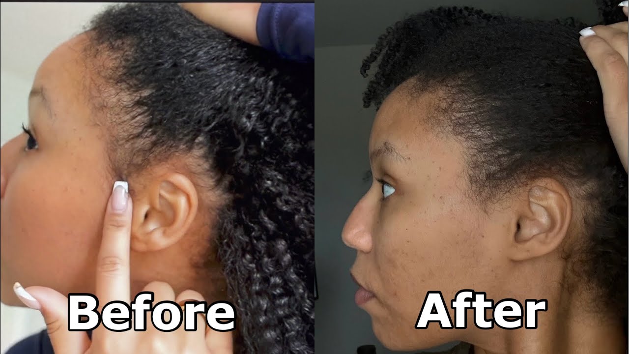 I’M BALDING??? | PRP Injections For Hair Growth Update Sessions 2 + 3