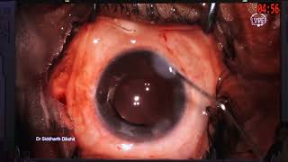 AIOC2026 IC164 migs Mayhem Complications They Don t Warn You About Dr Siddharth Dikshit