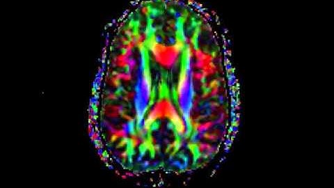 Diffusion Tensor Imaging DTI MRI - William Edward Hahn