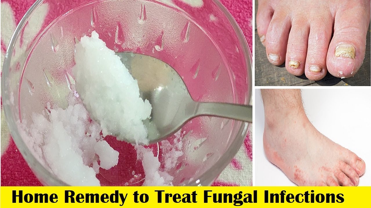 how get rid of yeast infection at home