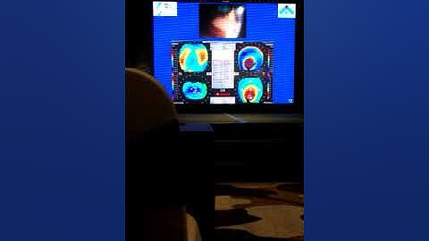 Nguyen ly Topography - Bản đồ giác mạc