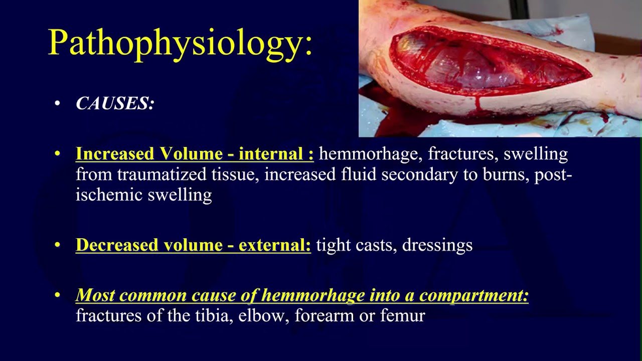 Compartment syndrome 1 - pathophysiology (OTA lecture series III g04a)