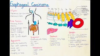 Esophageal Cancer  What you need to know