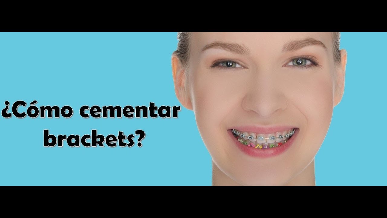 ¿Cómo cementar brackets de forma correcta? | 2021 | Diego Ubillús