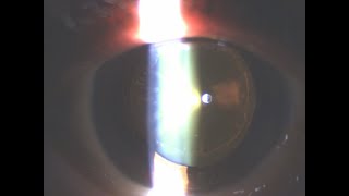 pseudoexfoliation & PSC type cataract surgery, phaco chop eyhance IOL