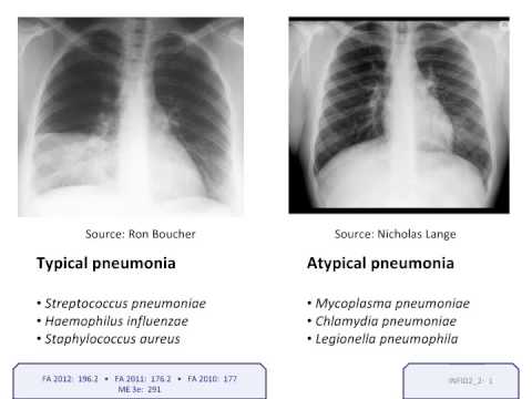 USMLE® Step 1 High Yield: Infectious Diseases: Pneumonia