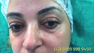 دكتور تجميل في مصر - شد الجفون في مصر – علاج تنفخات العيون في مصر