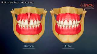 Soft tissue laser frenectomy for reducing gap between teeth screenshot 3