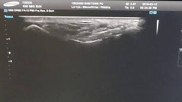 Hydrodissection of tibial nerve below medial malleolus