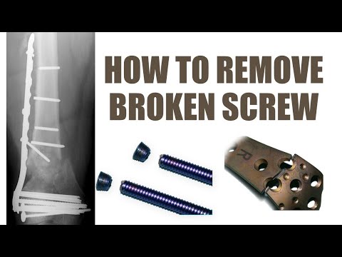 Skills Lab : Damaged Implant Removal - How To Remove Broken Screw