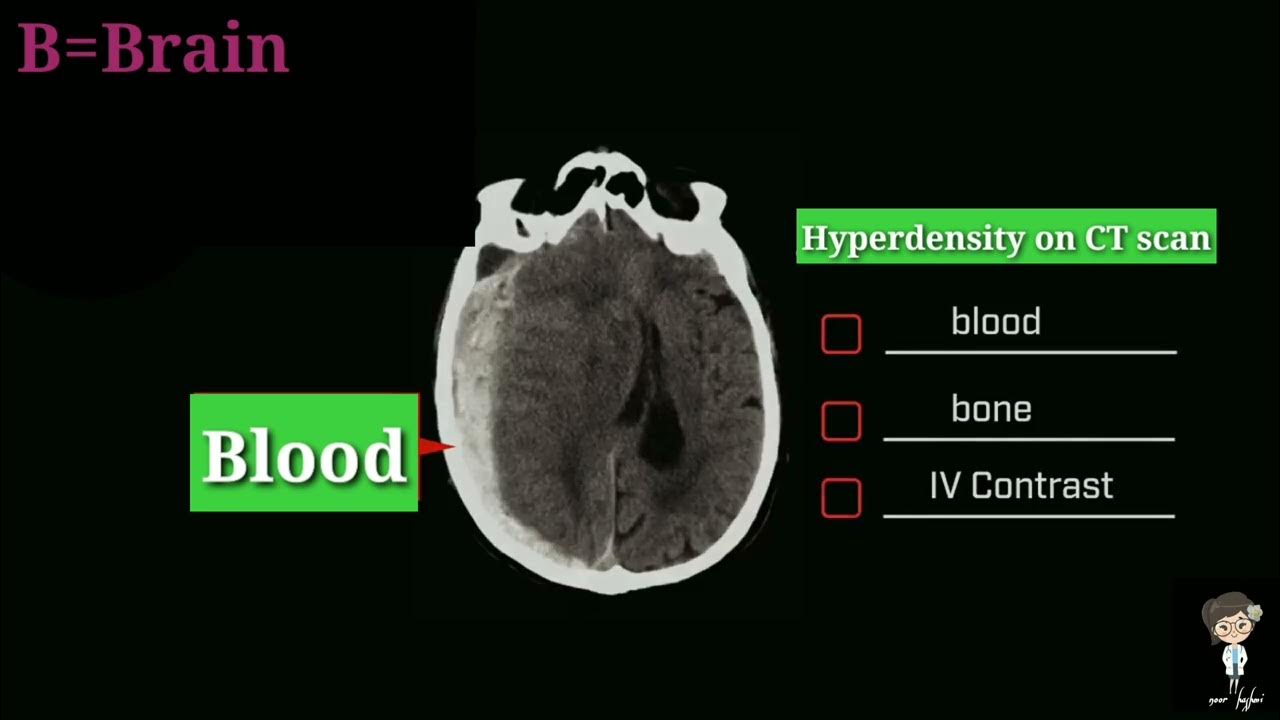 How to read ct scan brain in 5 minutes with mnemonics youtube