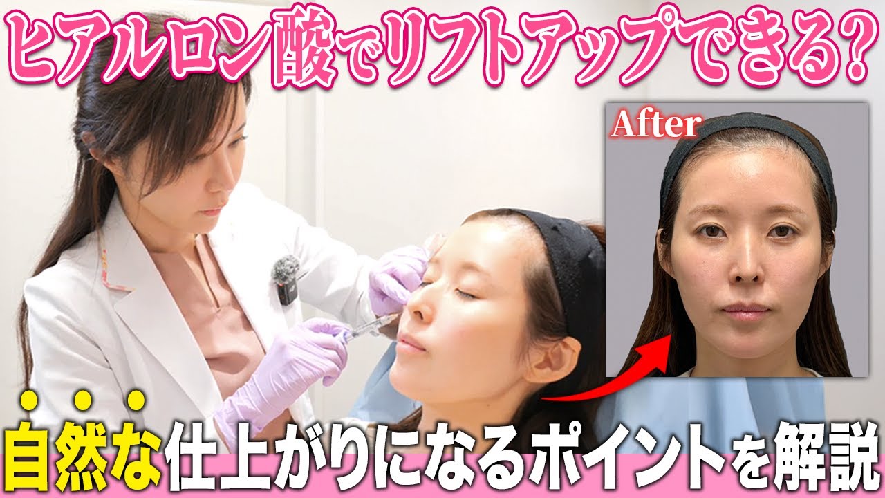 ヒアルロン酸注射で自然に若返る秘訣を実際に施術をしながらお見せします