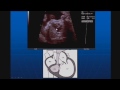 Ultrasound of the Fetal Heart What You Should Know
