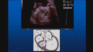 Ultrasound of the Fetal Heart What You Should Know