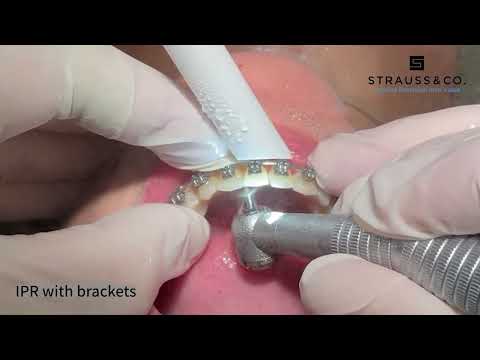 J316 IPR Diamond Bur Clinical Demonstration | Dr. Gilad Har-Zion | Strauss \u0026 Co.