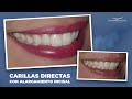 CARILLAS CON ALARGAMIENTOS INCISALES EN DIENTES OSCUROS