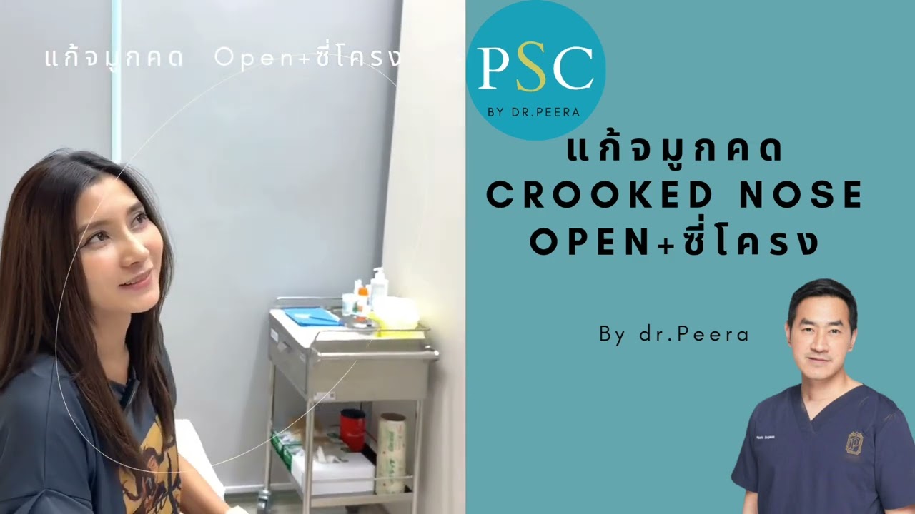 แก้จมูกคด! + เสริมจมูก open เป็นอย่างไร มาดูกันค่าา  👍