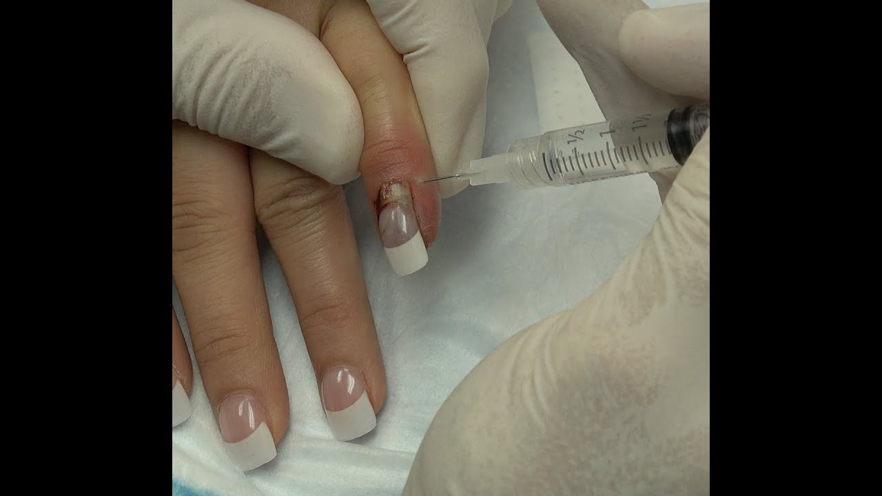 Creek Mom Tuft Fracture, Nail Splint Suture, Really! YouTube