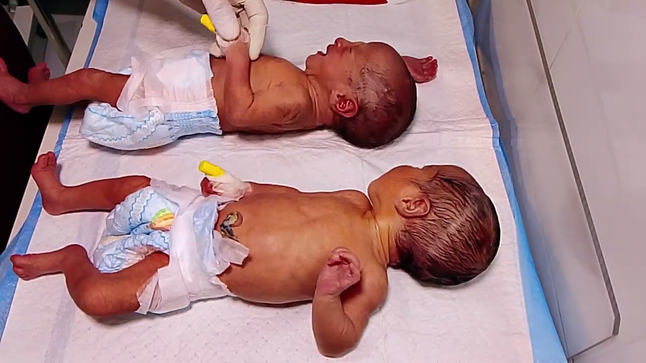 NNJ NICU Baby Care – Twins Baby (Simple Guide)NNJ = Neonatal Nursery/Neonatal UnitNICU