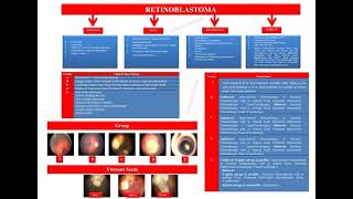 Retinoblastoma Made Easy By Prof Dr Hussain Ahmad Khaqan