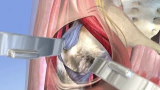 Running after joint replacement surgery