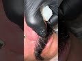 Big nose removal #skincare #beauty #asmr