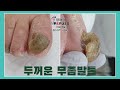 “아파서 못걷겠어요”무좀발톱 통증 없이 관리 part 1! Getting rid of thick black fungal toenails part 1!