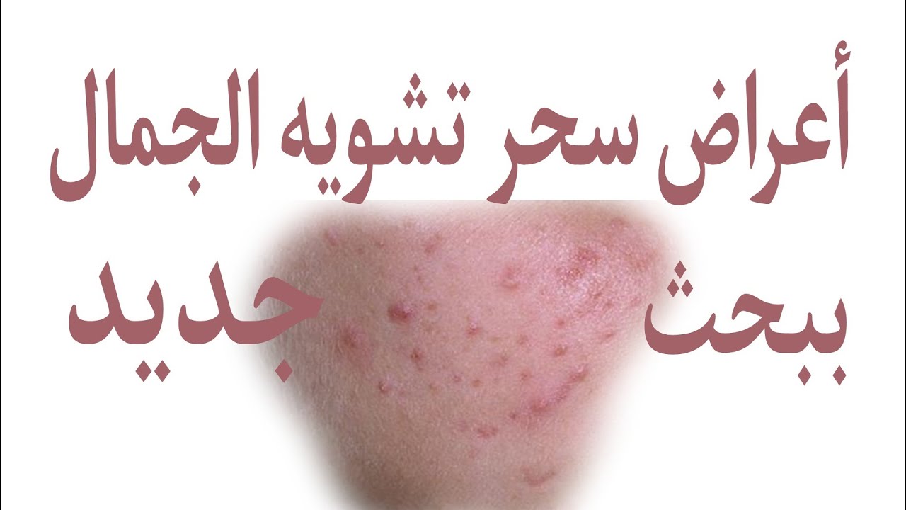 علامات سحر تشويه الجمال ، السحر هو الذي يغير لون وجهك ويجعله  مليئا بالأمراض الجلدية