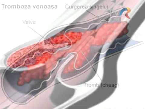 Video: Tromboza Vaselor Mezenterice - Simptome și Tratament