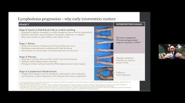 Breast Cancer-Related Lymphedema & Management: Modern Risk Assessment, Surveillance & Care Pathways